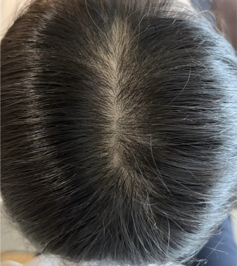 育毛鍼+幹細胞 6回施術後の頭皮