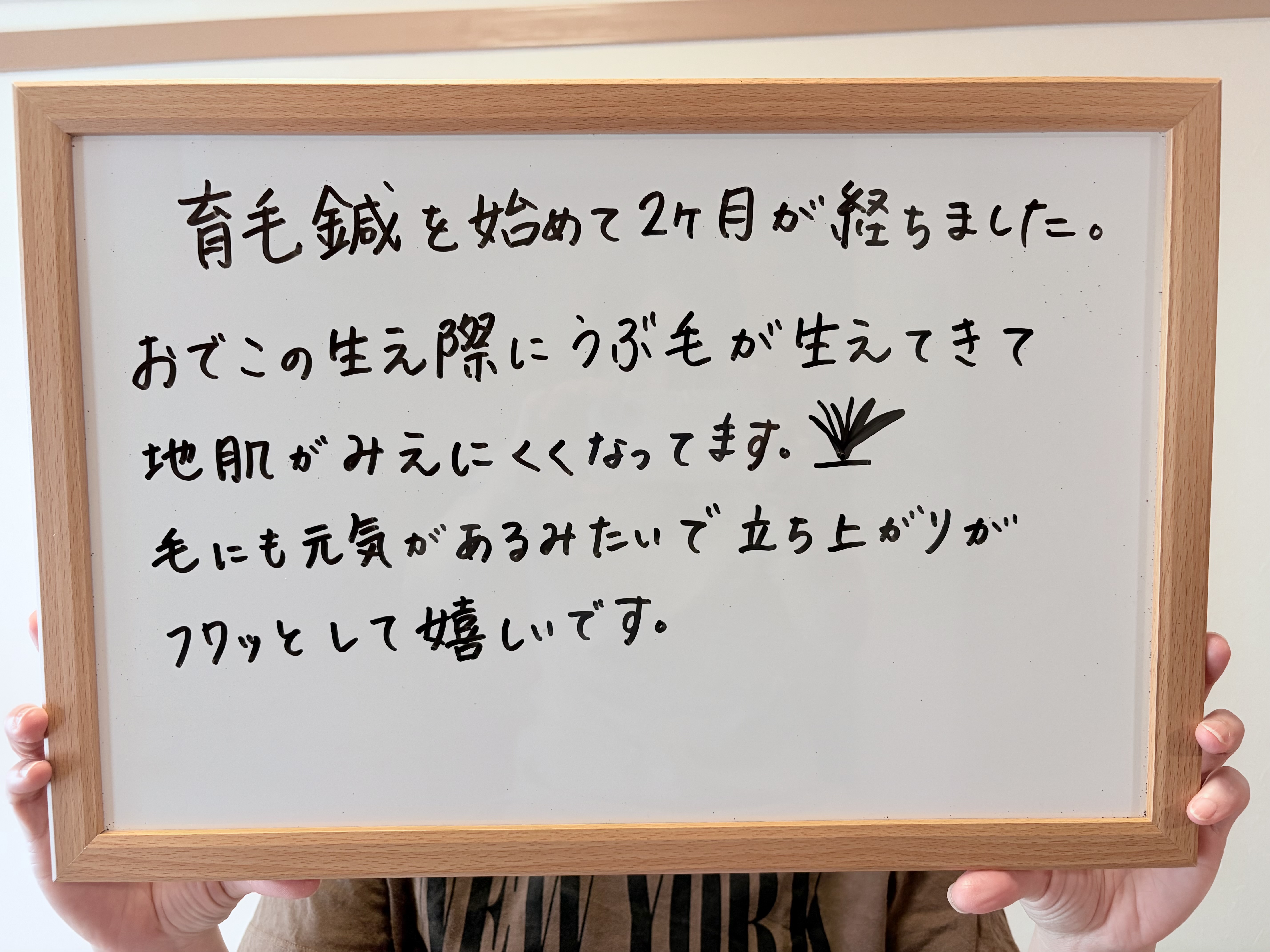 47歳女性 育毛鍼のお客様の声